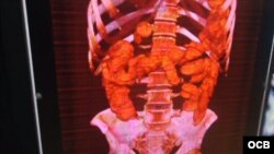 Radiografía muestra las cápsulas con estupefacientes en el organismo del viajero arrestado en La Habana.